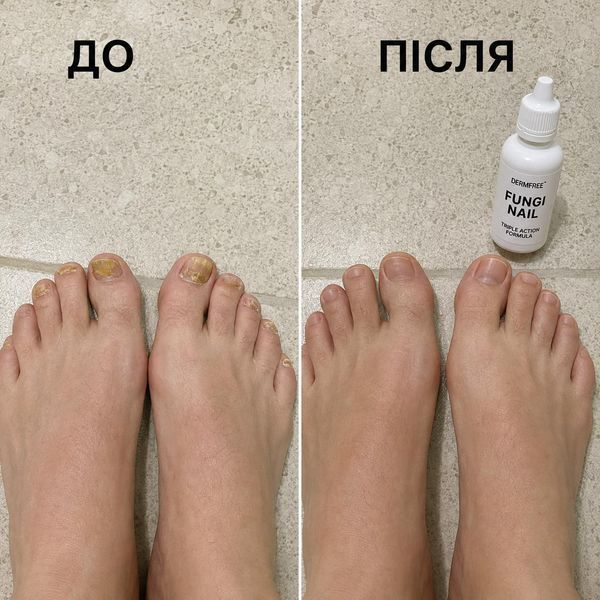 Засіб проти грибка нігтів Fungi Nail, 30 мл FUNGI-NAIL-30 фото